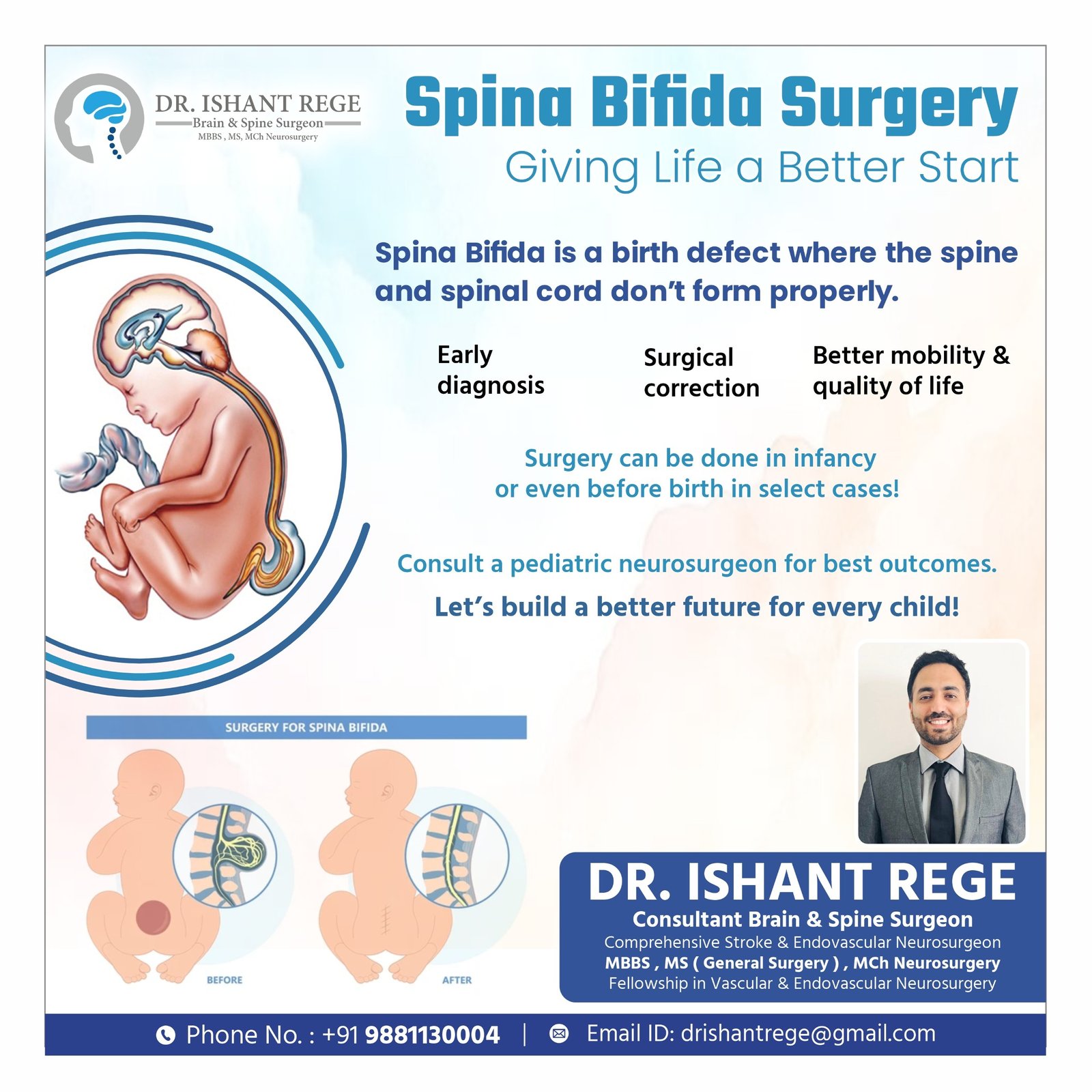 Spina Bifida Surgery — Giving Life a Better Start